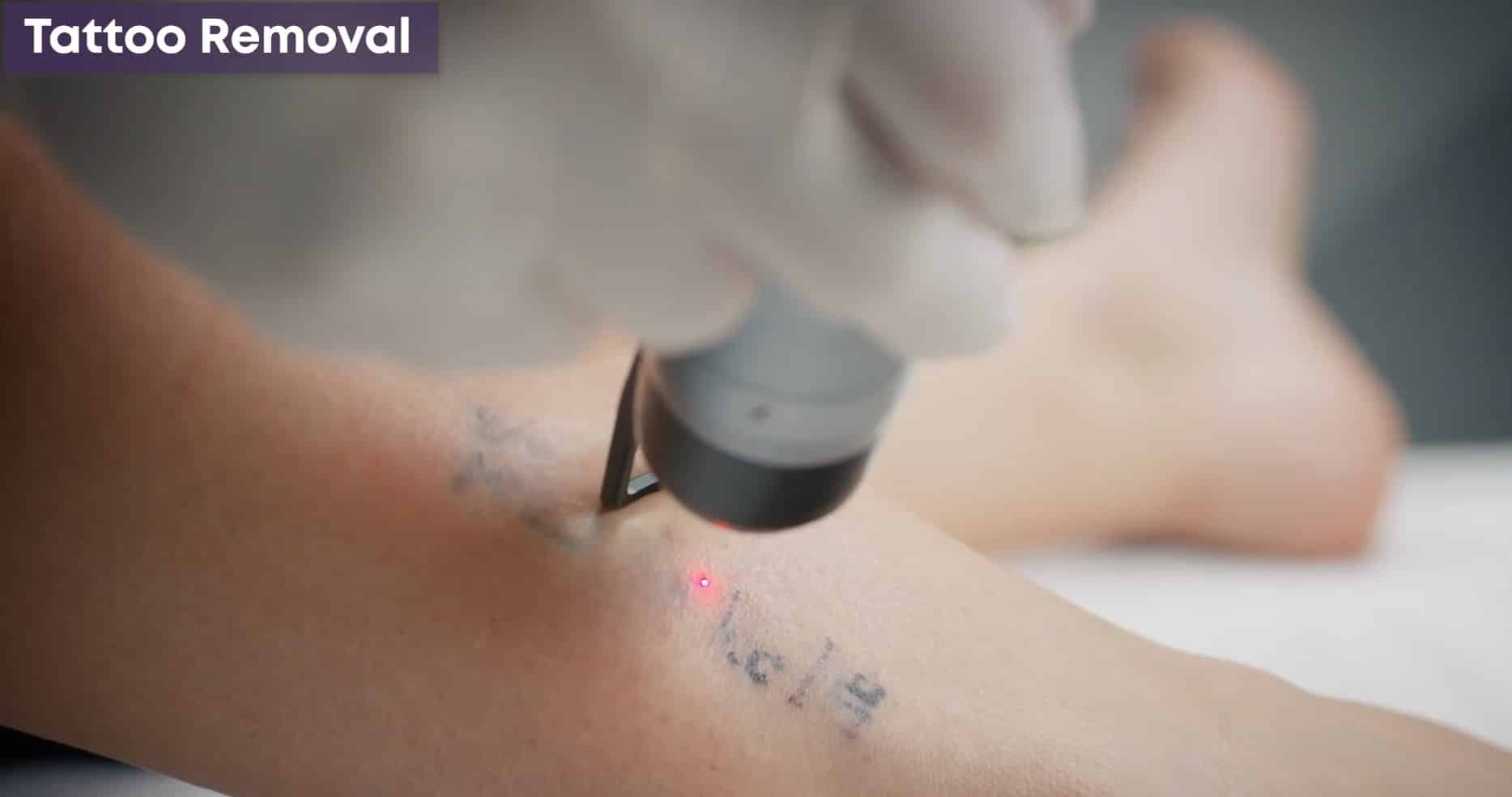 Tattoo removal video cover