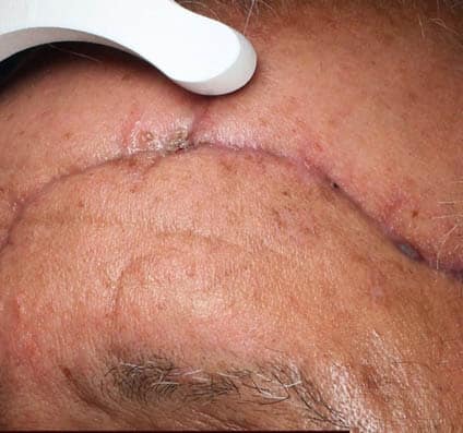 Alma Hybrid Scars Dr Artzi forehead b