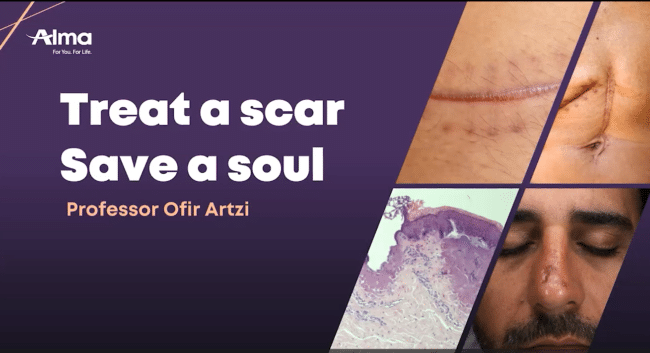 Scar management in the Hybrid era: A combined approach to the treatment of scars.